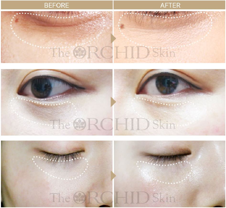 The Orchid Skin Smoky Under Clear Eye Patches 2.3gx10 Pcs Pads Masks