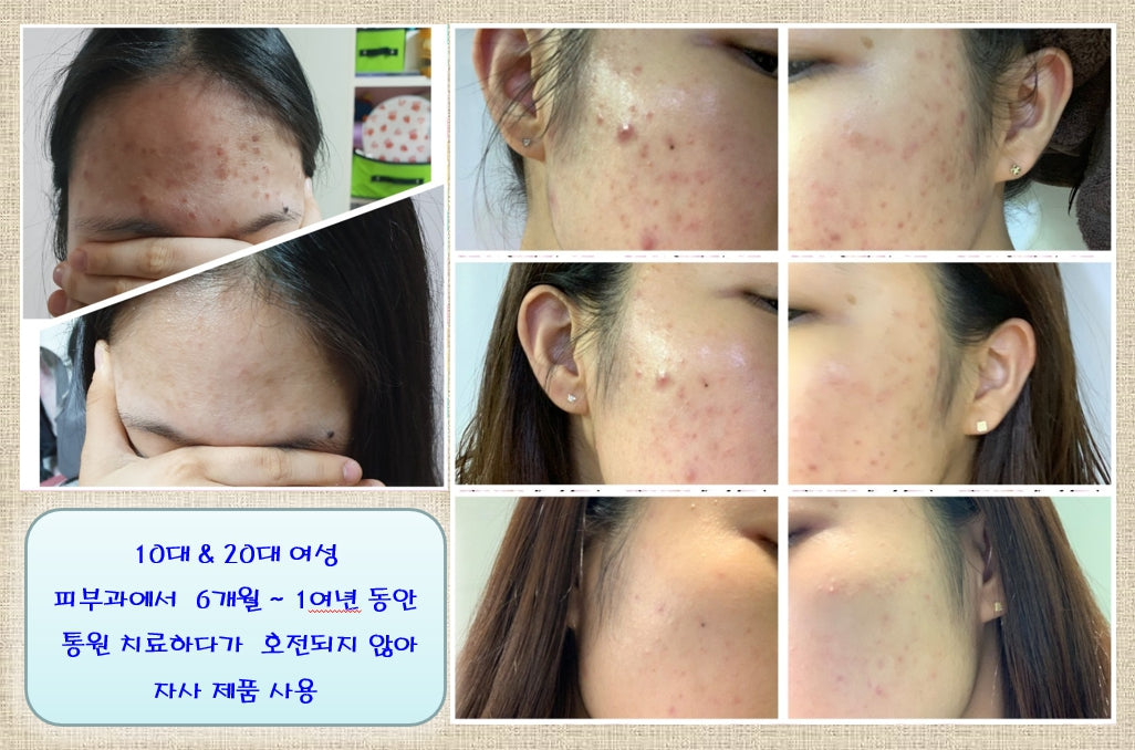 Basic Concept Creams Trouble Acne Atopy Sensitive Skincare Facial Moisture