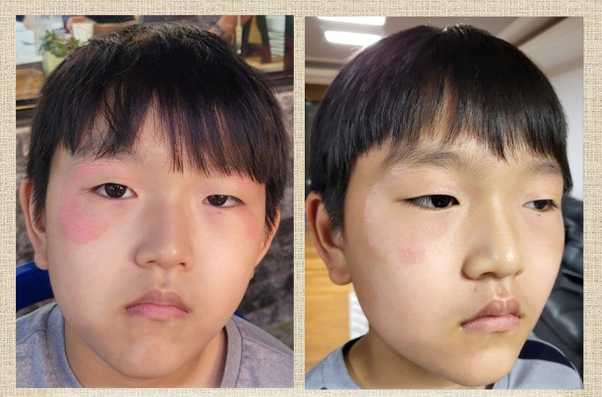 Basic Concept Creams Trouble Acne Atopy Sensitive Skincare Facial Moisture