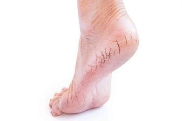 Il-Yang Pharmaceutical Foot Care Creams 60g treats cracked heels