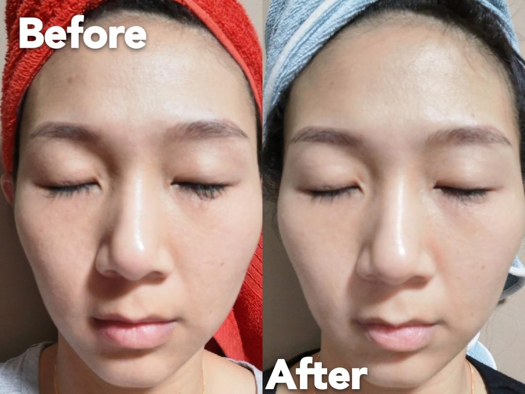 Rejuran Healer Healing Masks Damaged Skincare Treatments Wrinkles Soothing