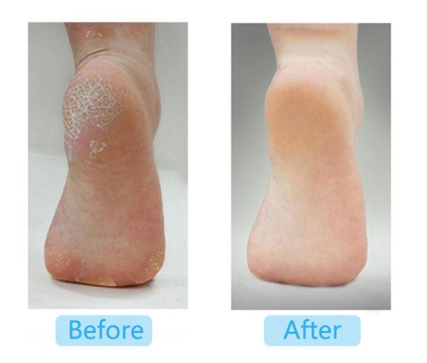 Callus Remover Dead Skincare Exfoliating Pedicure Footfile Tools