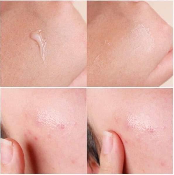 5 Pieces Dong-A Pharm Noscarna Acne Scars Removal Gels Face Facial Creams Large Size 20g Best help for getting rid of pimples Decent spot Treatments Easy to apply Doesn’t have an odor fading burn