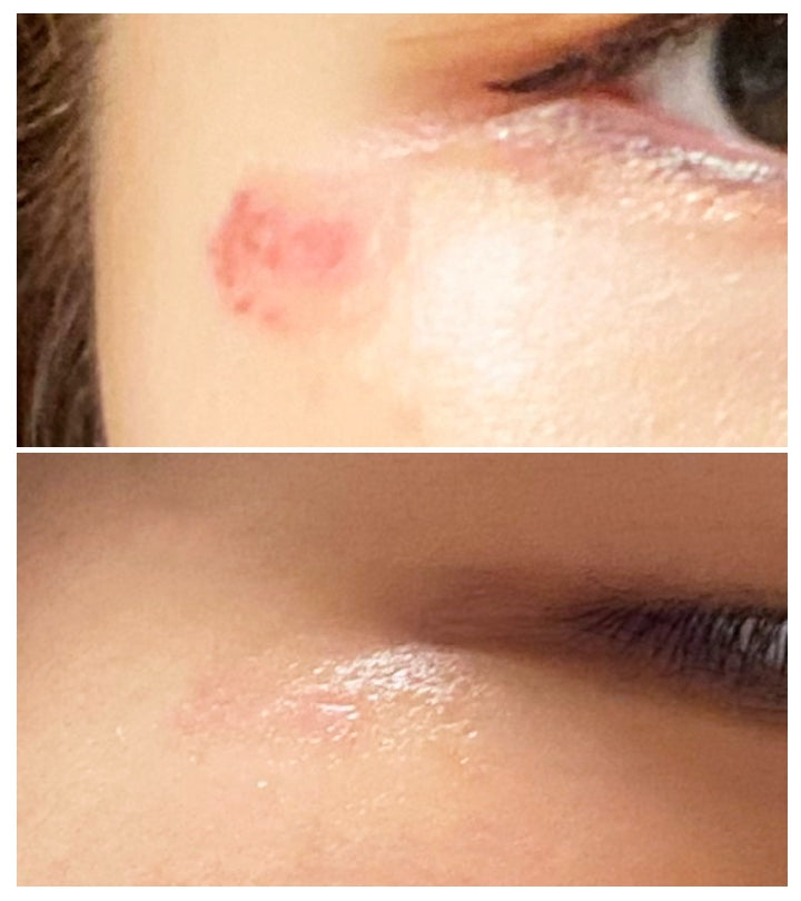 Dong-A Pharm Noscarna Acne Scars Removal Gels Face Facial Creams Large Size 20g Best help for getting rid of pimples Decent spot treatment Easy to apply Doesn’t have an odor fading burn