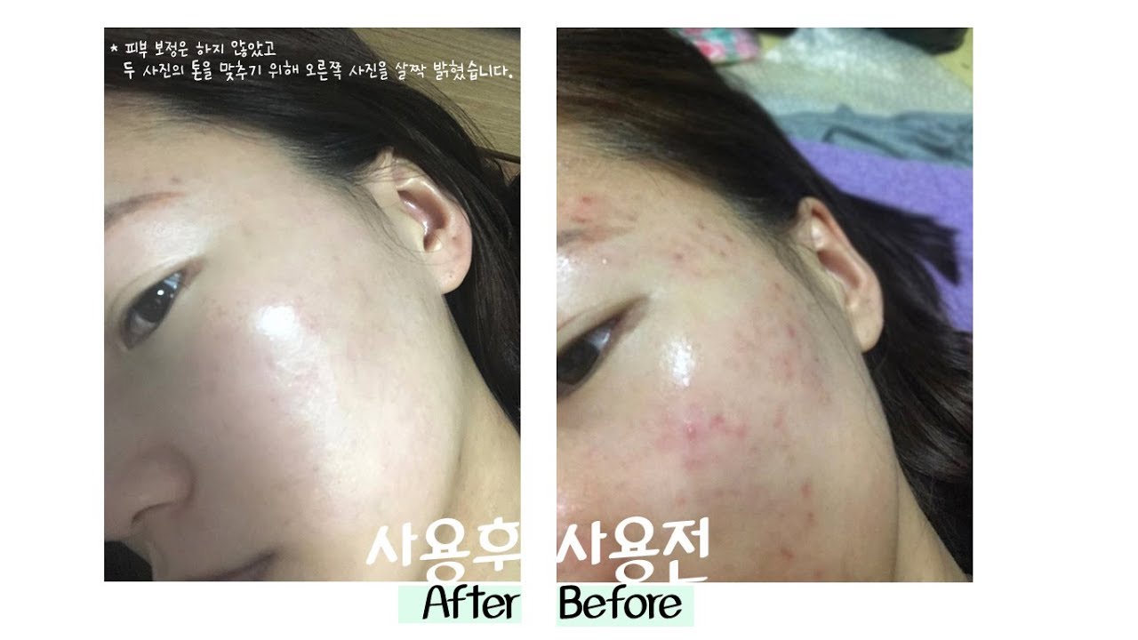 Dong-A Pharm Noscarna Acne Scars Removal Gels Face Facial Creams Large Size 20g Best help for getting rid of pimples Decent spot treatment Easy to apply Doesn’t have an odor fading burn