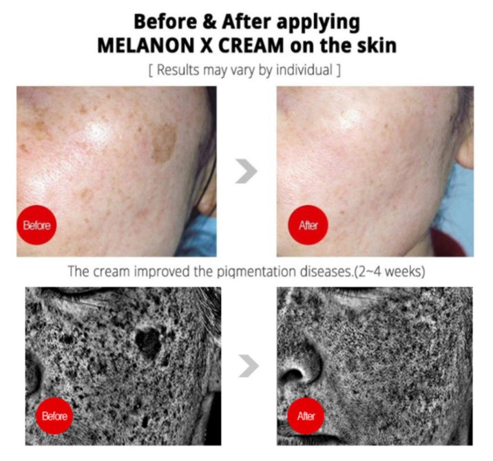 MEDI-PEEL Melanon X Cream 30ml Skin Brightening Whitening  freckles